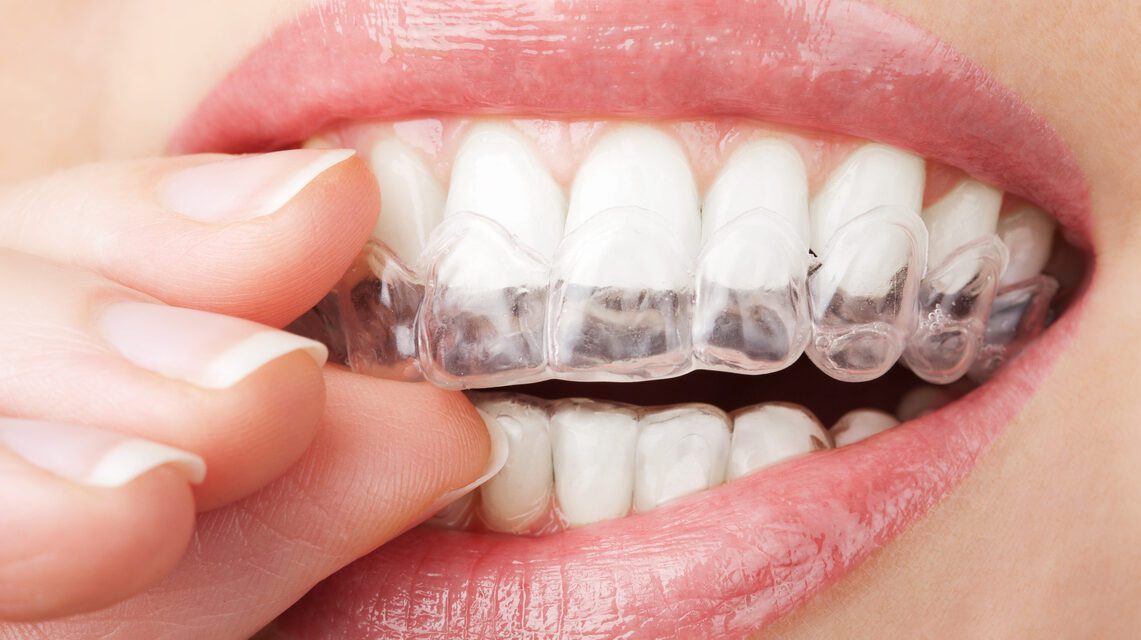 Invisalign in Grimsby: The Clear Path to a Straighter Smile