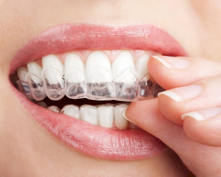https://dentistryatwaterview.com/wp-content/uploads/2021/06/invisalign1-768x618-1.jpg