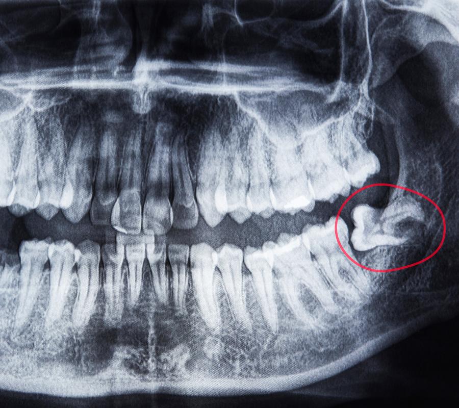 Professional wisdom teeth removal in Beamsville, ON