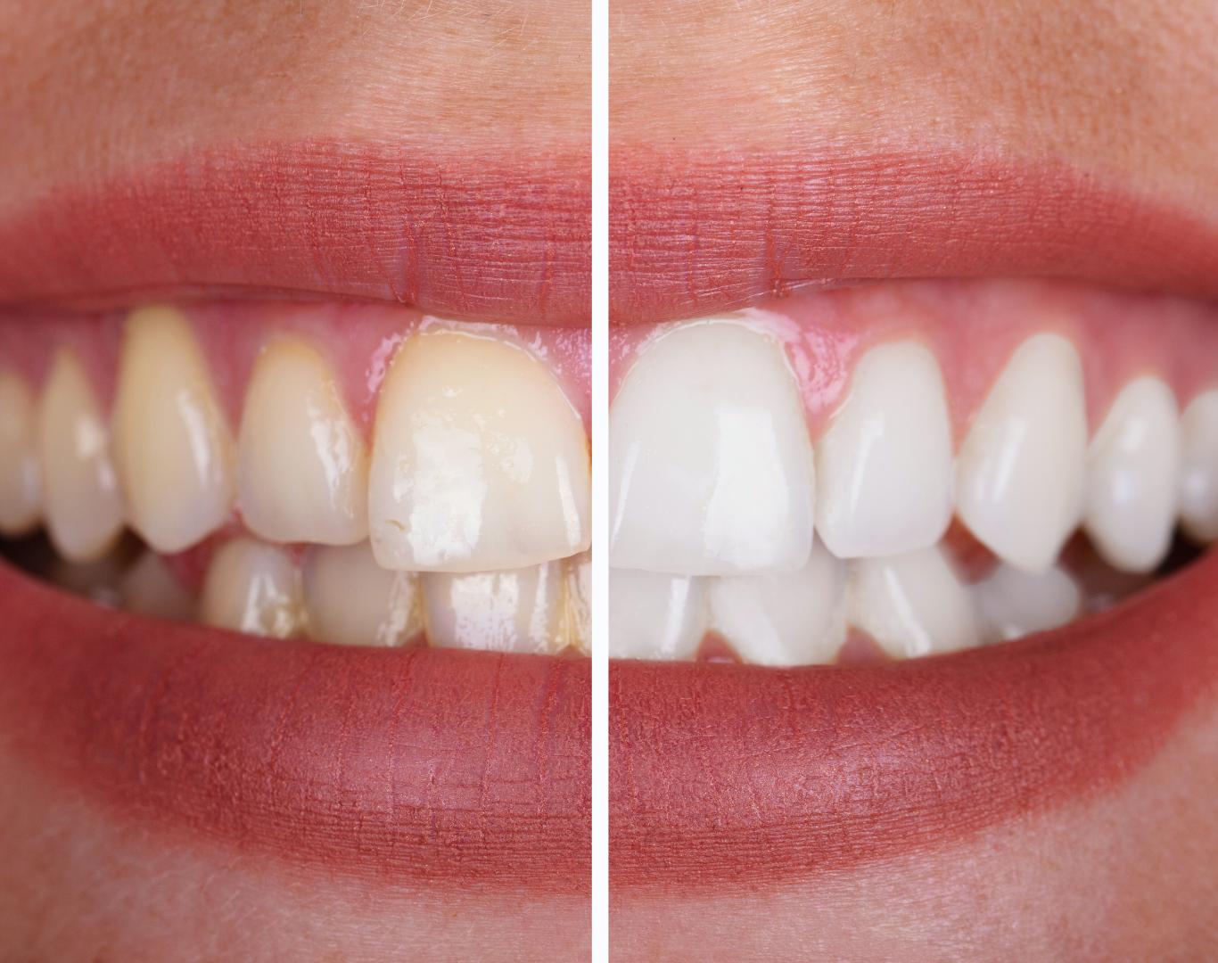 Before and after teeth whitening near me by Dentistry at Waterview