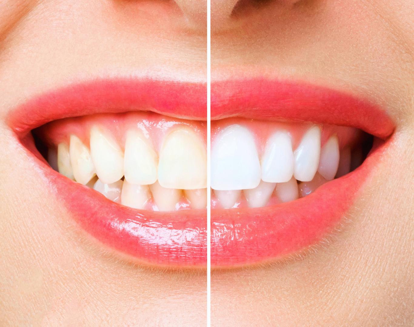 Patient before and after teeth whitening near me at Dentistry at Waterview