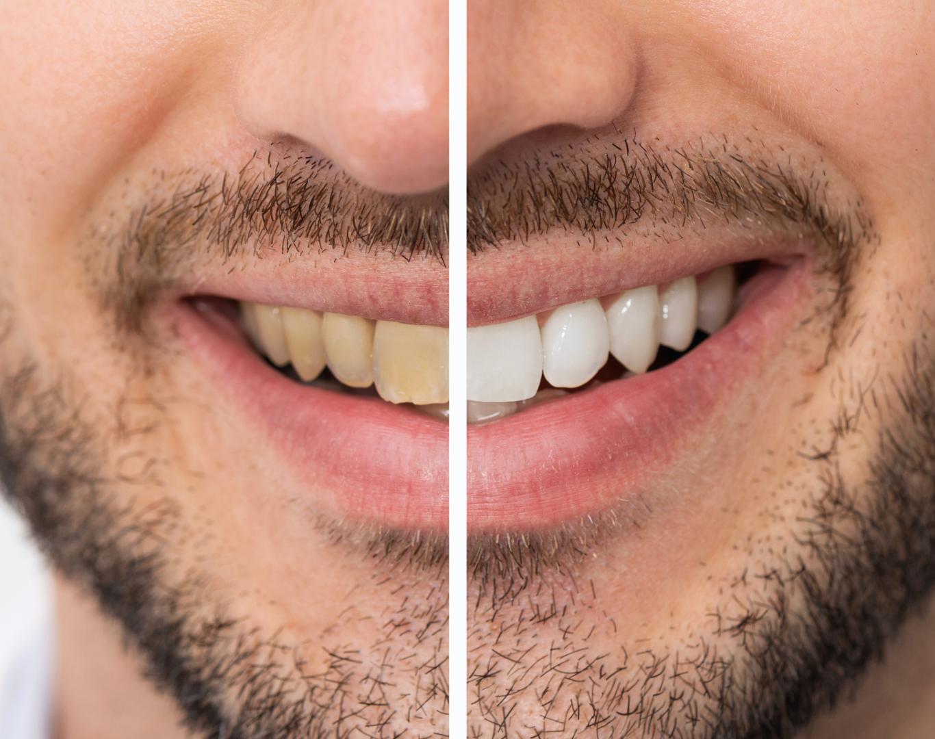 Before and after cosmetic dentistry near me at Dentistry at Waterview
