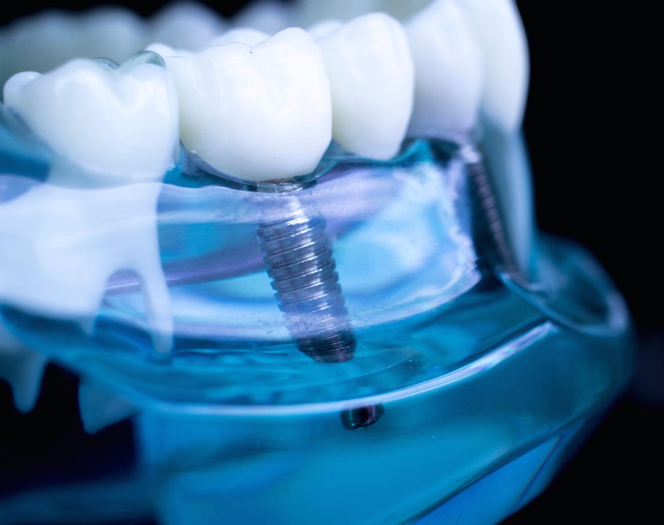 Advanced full mouth implants near me in Beamsville, ON for smile reconstruction