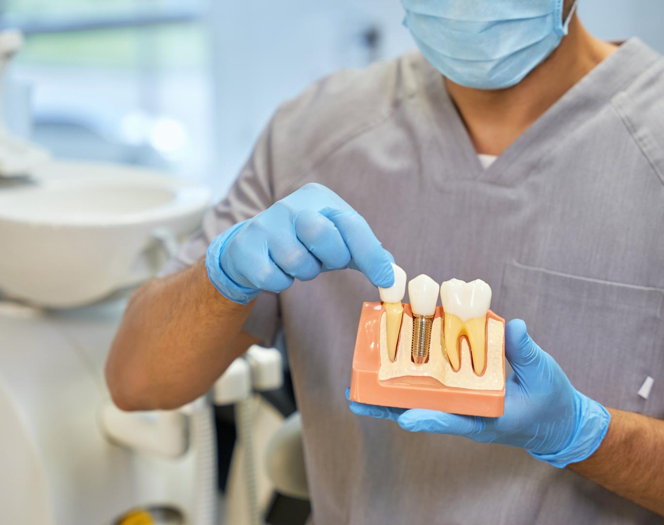 Full Mouth Dental Implants