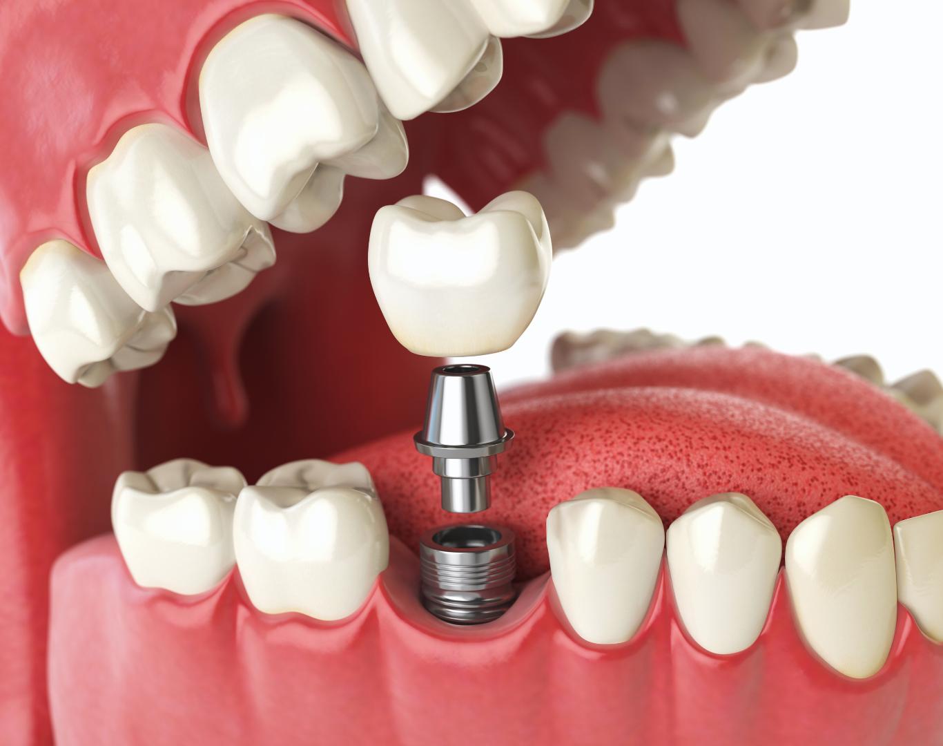 Full mouth dental implants in Beamsville, ON for complete tooth restoration