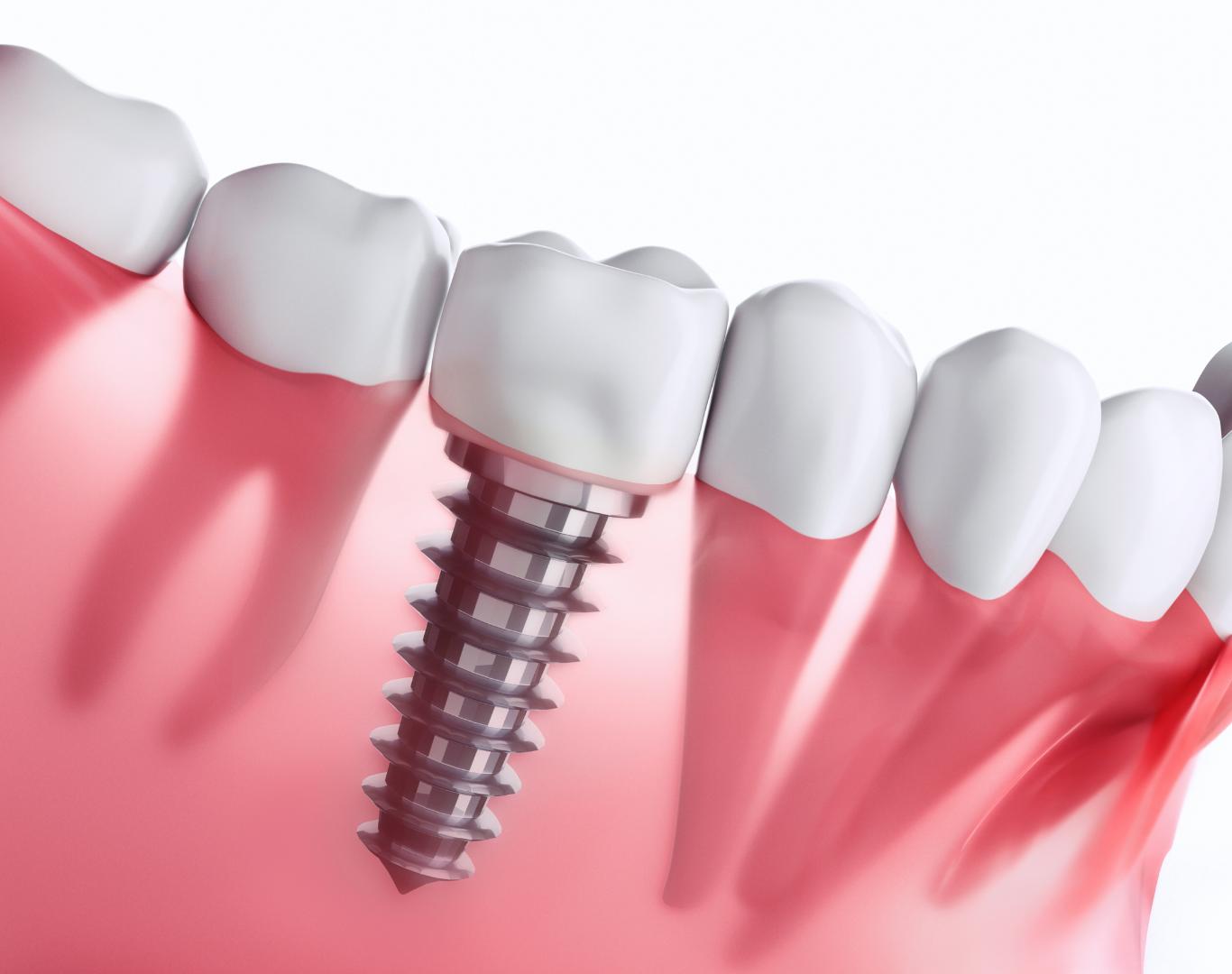 Full mouth dental implants in Smithville, ON for complete tooth replacement