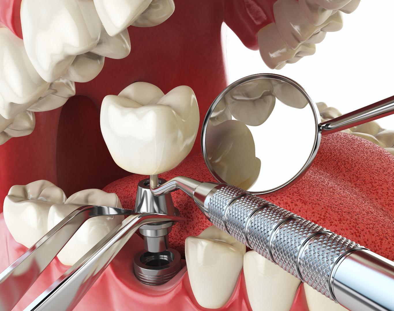 Full mouth dental implants in Stoney Creek, ON for complete smile restoration