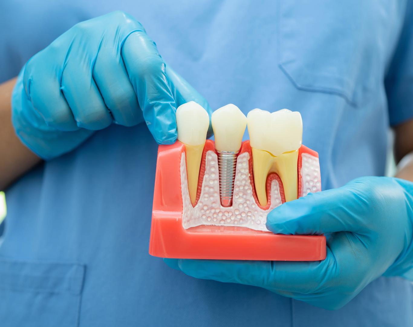 Secure full arch implants near me in Stoney Creek, ON by expert dentists