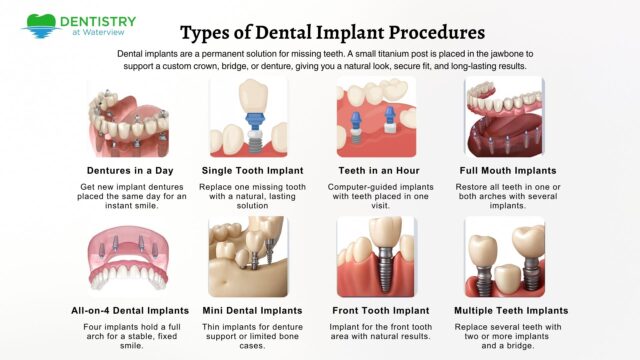 Types of Dental Implant Procedures