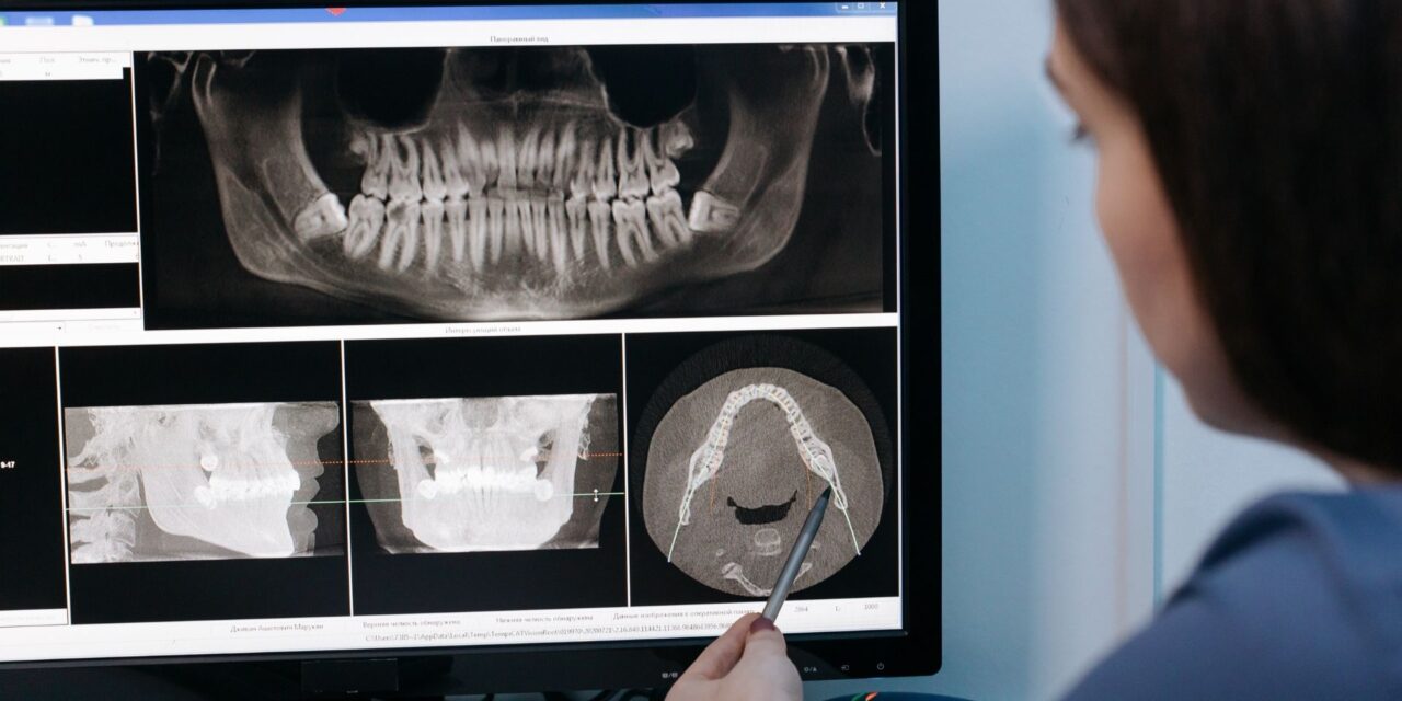 Guide to Find the Best All-on-4 Dental Implants in Grimsby