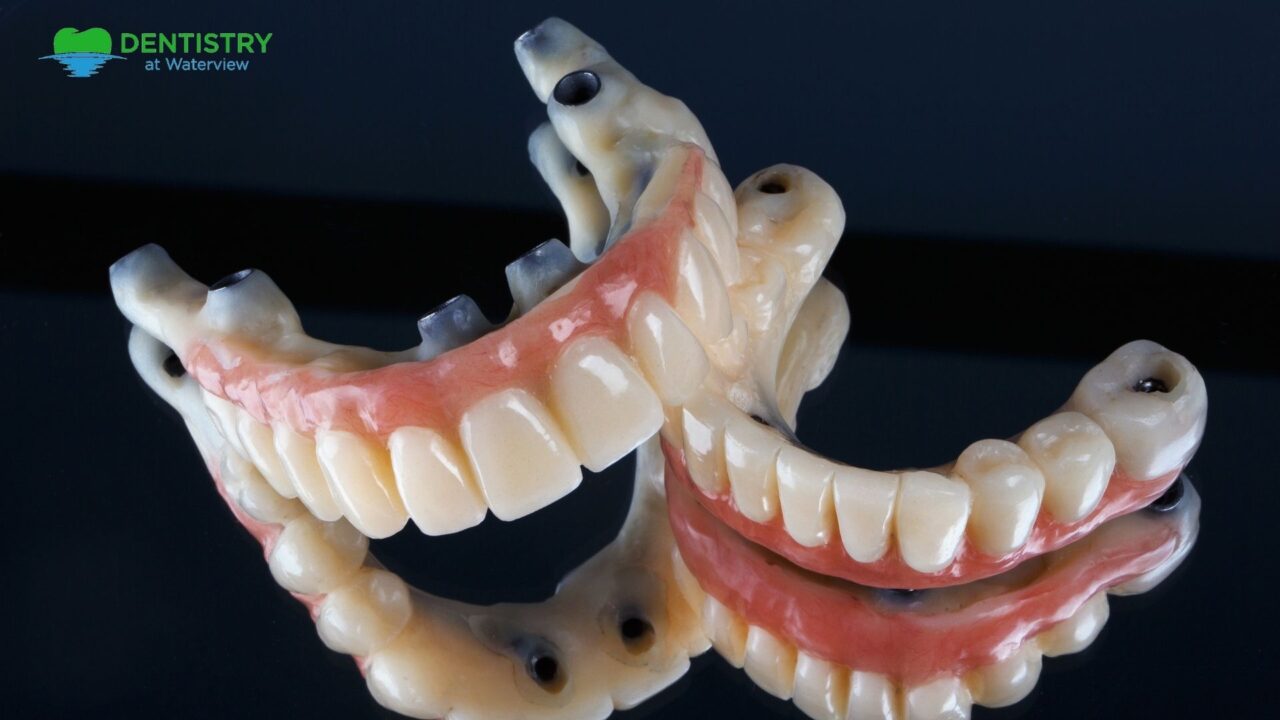 All-on-4 Dental Implants Image