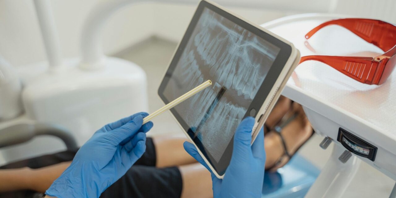 Guide to Find the Best All-on-4 Dental Implants in Stoney Creek