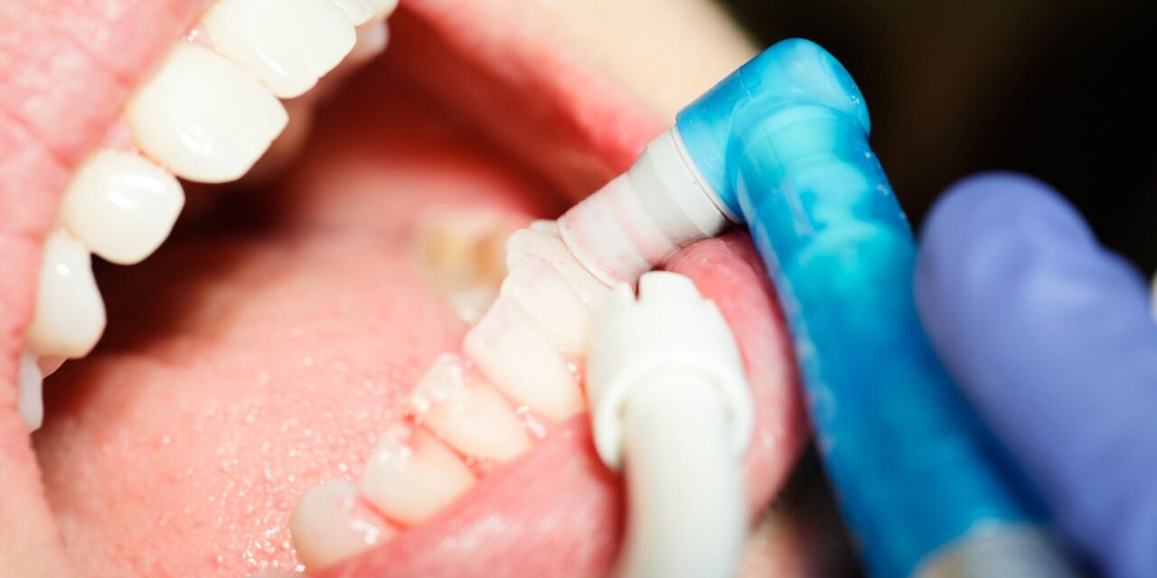 What Happens During a Dental Cleaning? A Step-by-Step Guide