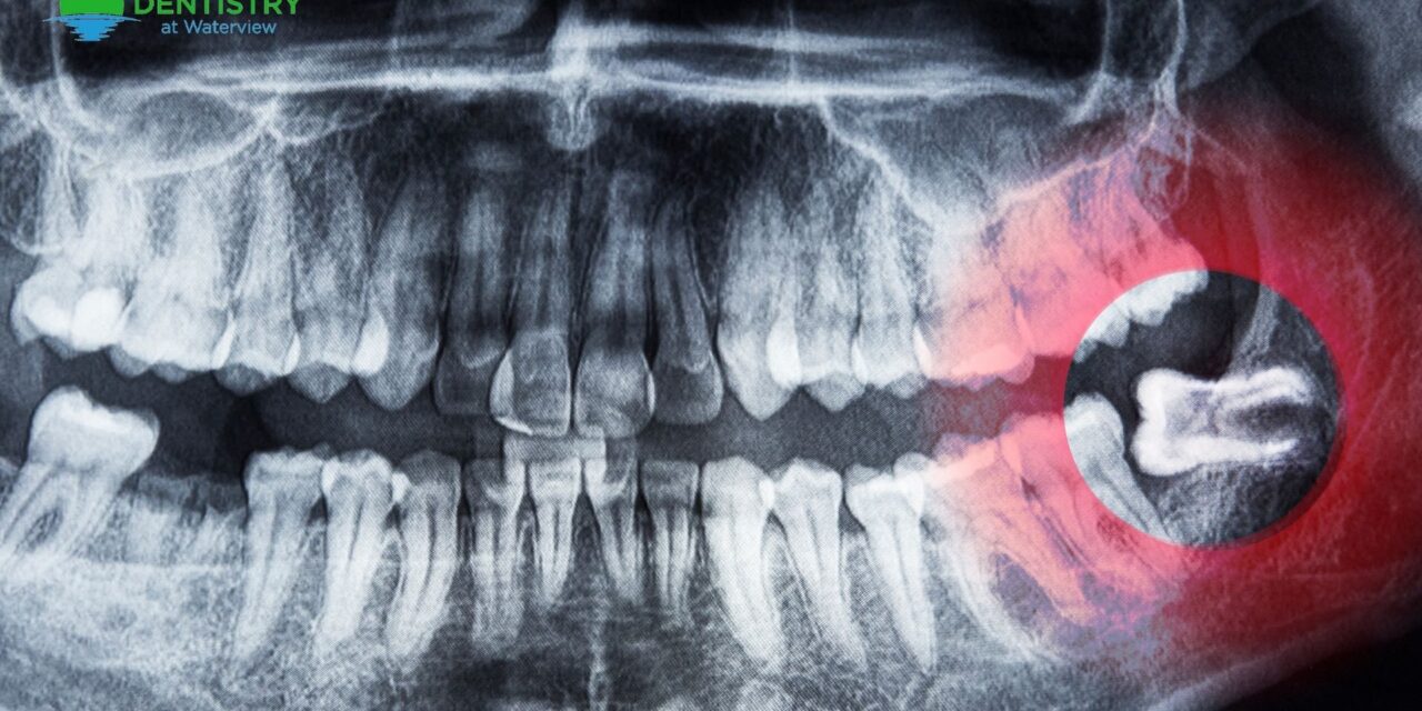Everything You Need to Know About Wisdom Teeth Removal