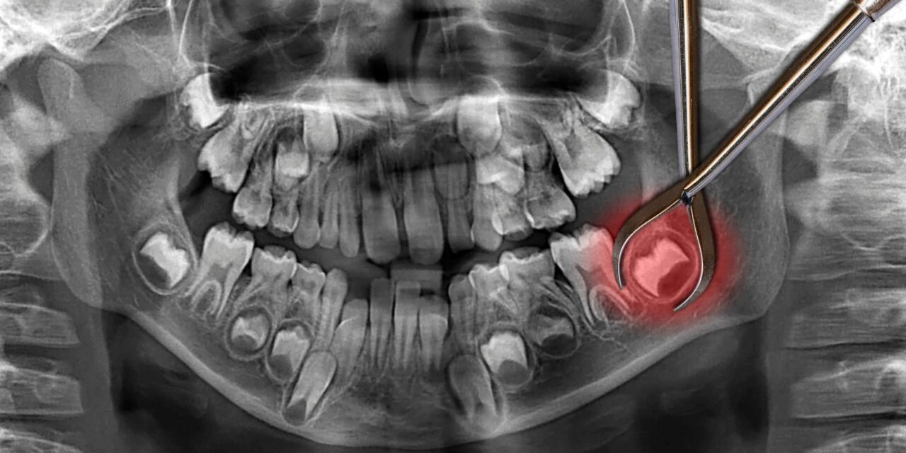 Wisdom Teeth Removal in Beamsville: Gentle, Safe, and Affordable Care