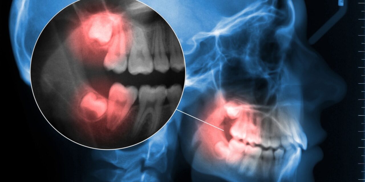 Wisdom Teeth Removal in Grimsby: Gentle, Safe, and Affordable Care