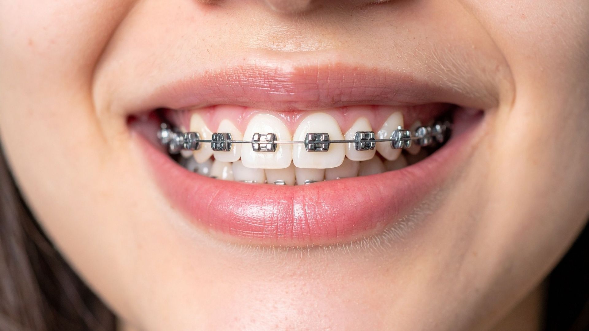 Braces Maintenance Guide