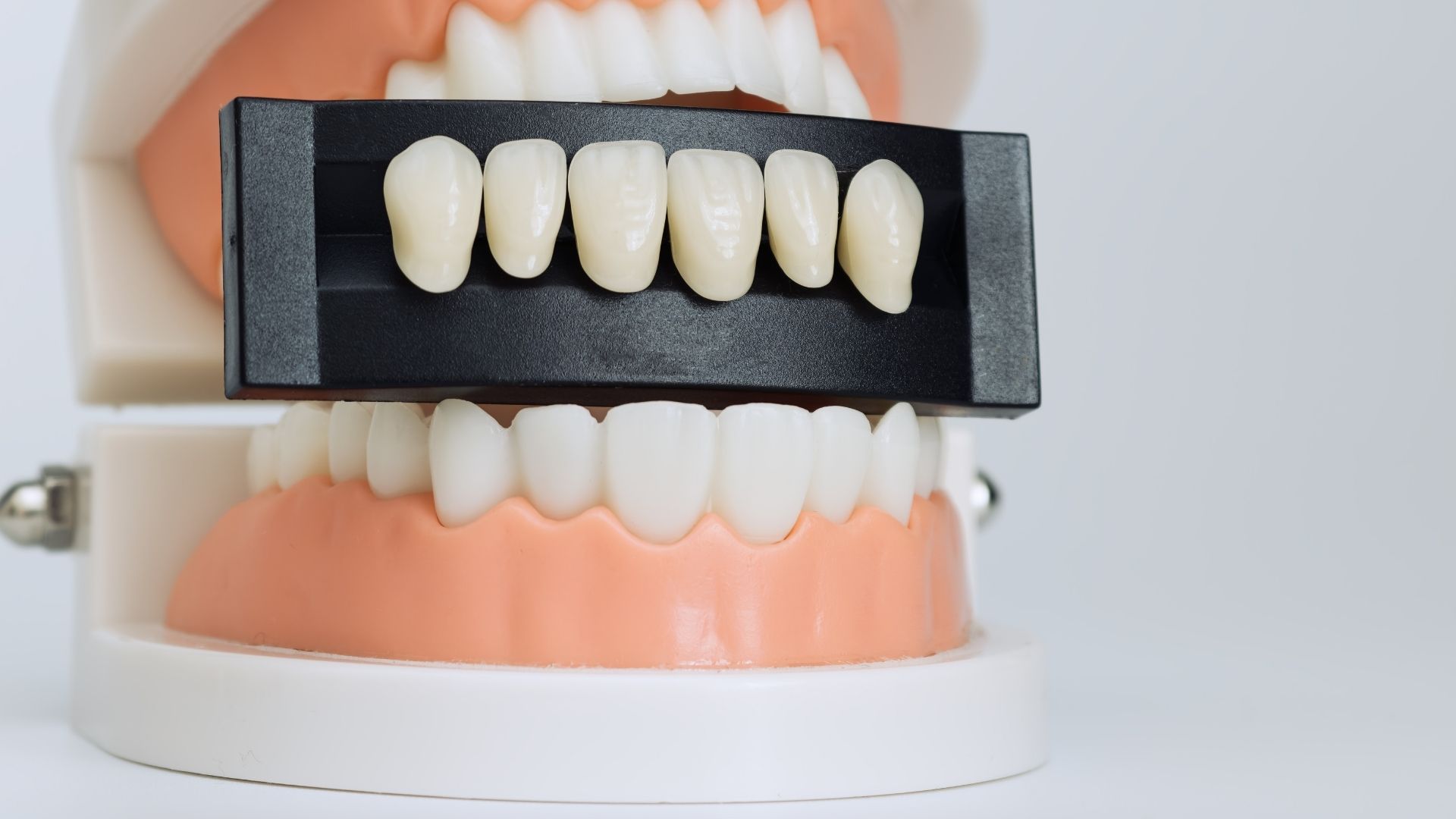 Composite Veneers