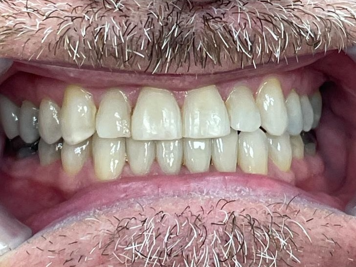 After Invisalign treatment - straightened teeth result at Dentistry at Waterview, Grimsby ON After Invisalign treatment - straightened teeth result at Dentistry at Waterview, Grimsby ON