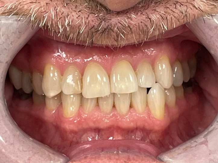 Before Invisalign treatment - crowded teeth patient at Dentistry at Waterview, Grimsby ON Before Invisalign treatment - crowded teeth patient at Dentistry at Waterview, Grimsby ON