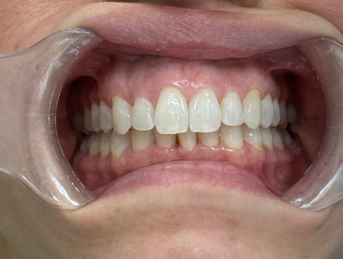 After Invisalign treatment - straightened teeth result at Dentistry at Waterview, Grimsby ON