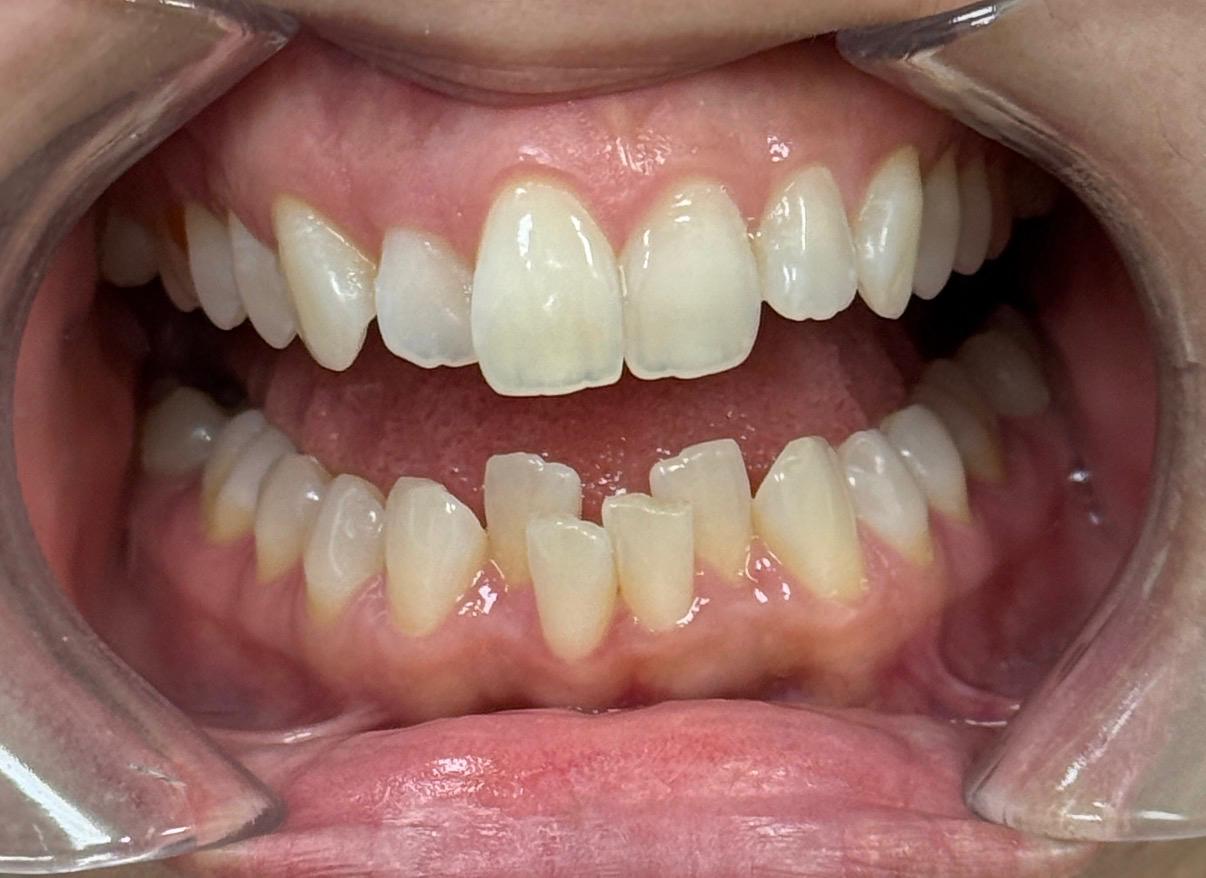 Before Invisalign treatment - crowded teeth patient at Dentistry at Waterview, Grimsby ON