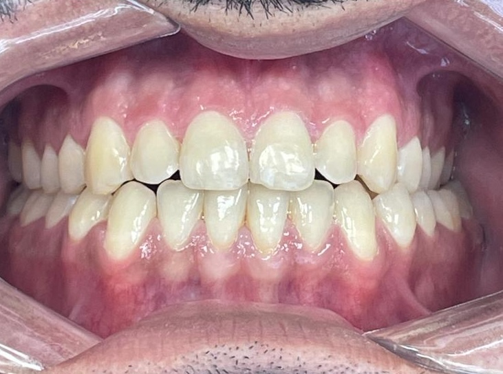 After Invisalign treatment - smile transformation result at Dentistry at Waterview, Grimsby ON