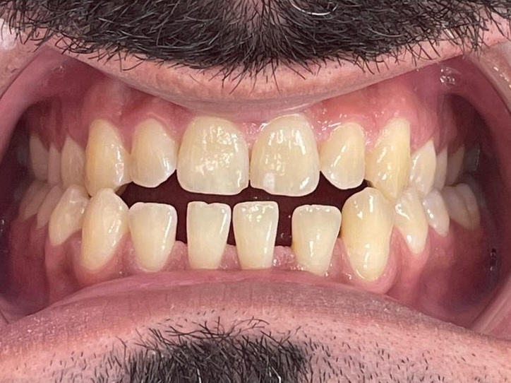 Before Invisalign treatment - misaligned teeth patient at Dentistry at Waterview, Grimsby ON